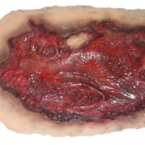 wound PNG image
